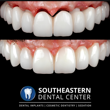 Porcelain Implant Bridge